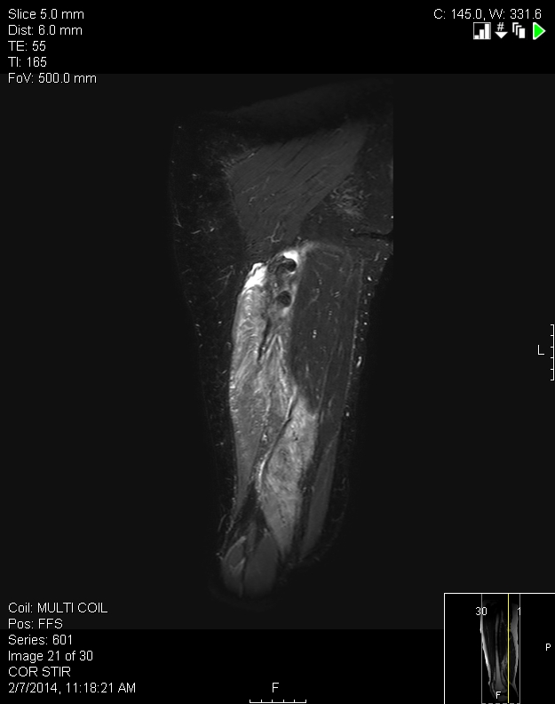 Hamstring Injuries Knee & Sports Orthobullets